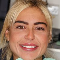 Composite Bonding - Smile 24 before